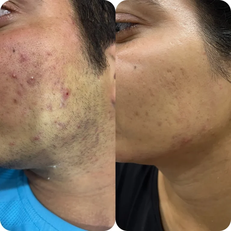 Luhach Beauty Hub Rohtak skin tratement 768x768